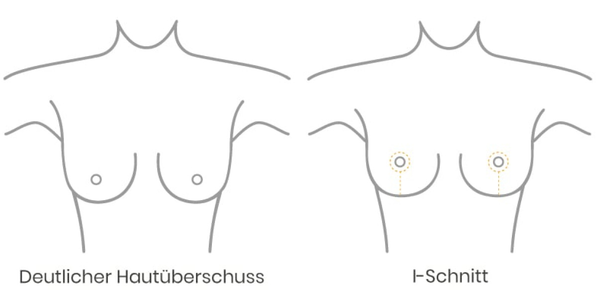 Deutlicher Hautüberschuss bei einer Bruststraffung