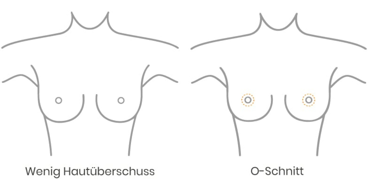 Wenig Hautüberschuss bei einer Bruststraffung