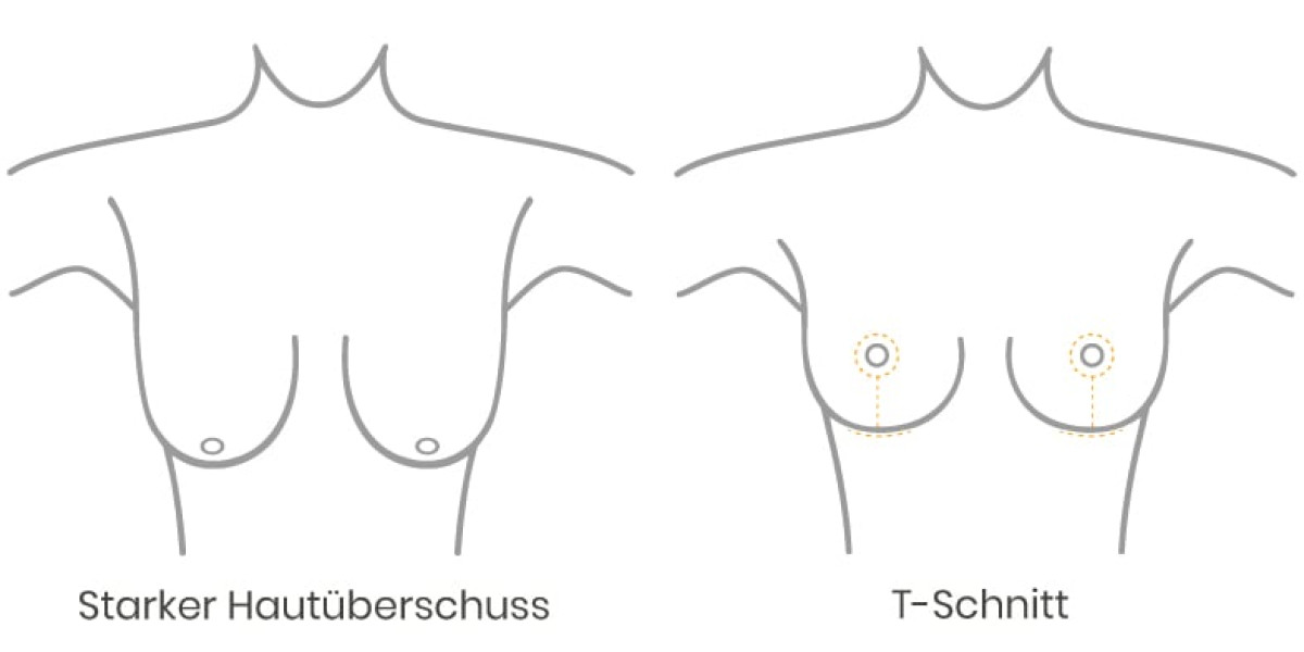 Starker Hautüberschuss bei einer Bruststraffung