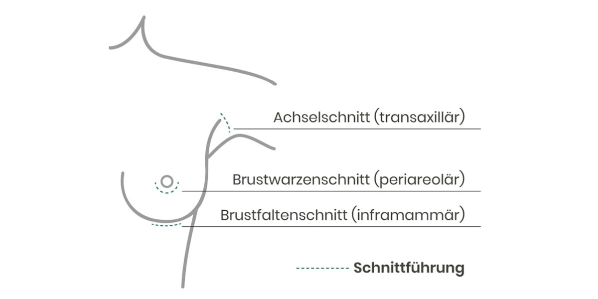 Schnittführung bei einer Brustvergrößerung